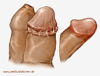 Beschneid-k